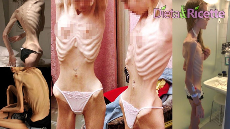donne anoressiche immagini anoressia diventare anoressica conseguenze